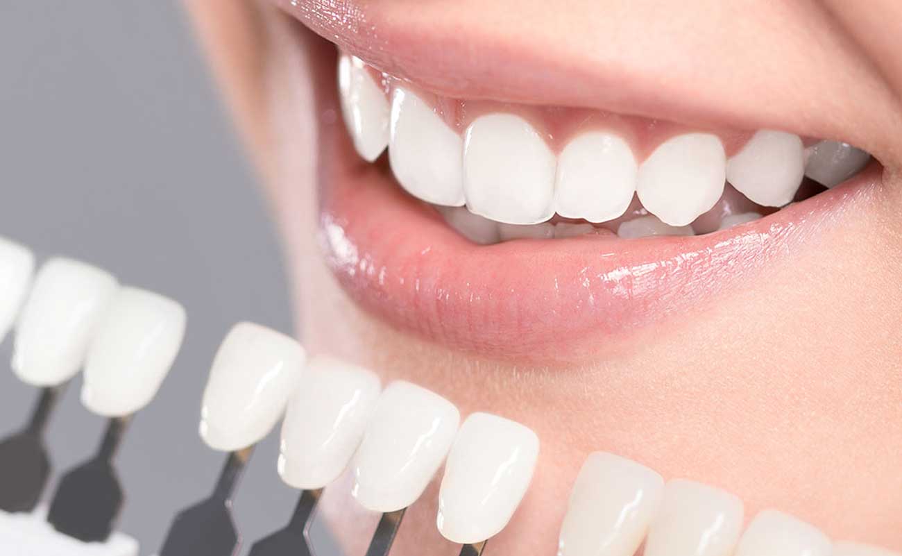 Teeth Whitening in Malaysia: Unlocking the Secret to a Radiant Smile